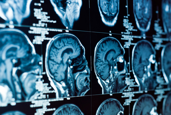 10 Things You Should Know About Brain Tumors